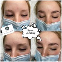 brow lifting 1