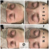 brow lifting 2